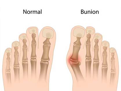 Bunions-Diagram-L.A.-Orthopedic-Pain-Center