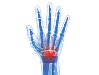 Carpal Tunnel Syndrome - L.A. Orthopedic & Pain Center