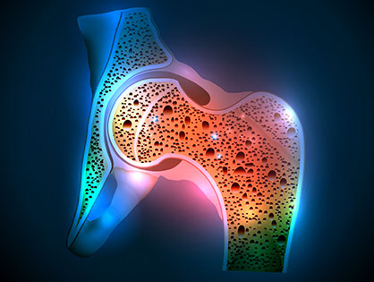 Osteoporosis-LA-Orthopedic-Pain-Center
