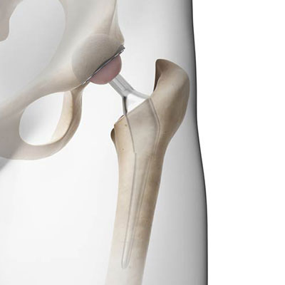 Total Joint Replacement