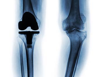 otal-Joint-Replacement-L.A.-Orthopedic-Pain-Center
