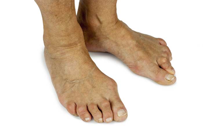 Bunions - L.A. Orthopedic & Pain Center