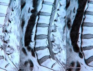 Degenerative Disc Disease - LA Orthopedic & Pain Center