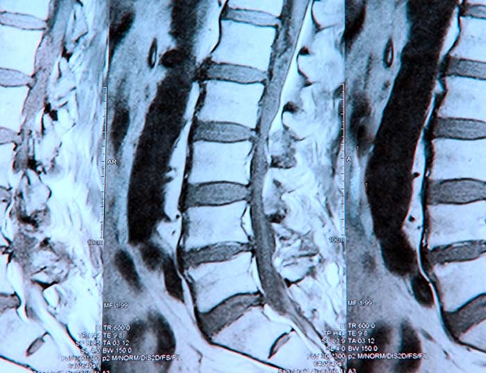 Degenerative Disc Disease X-Ray - L.A. Orthopedic & Pain Center