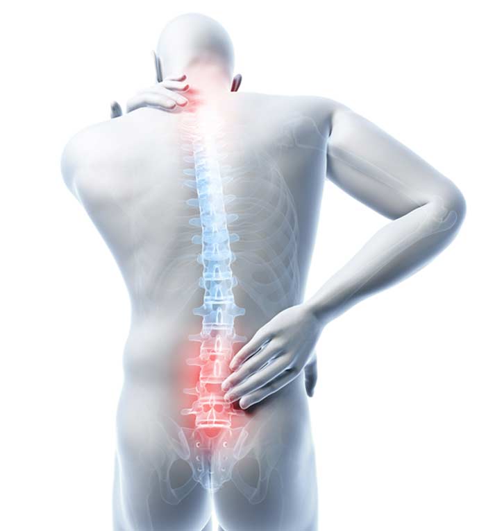 Failed Back Surgery Syndrome CGI - L.A. Orthopedic & Pain Center