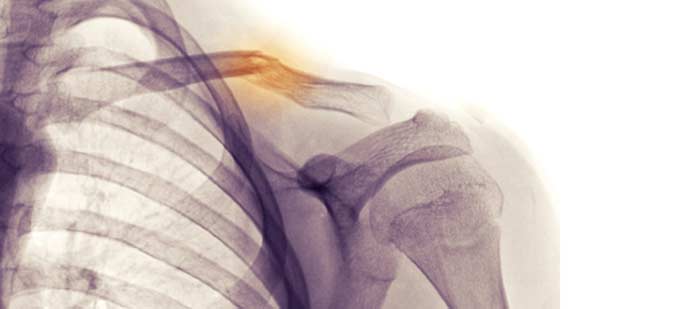 Fractures in X-Ray - L.A. Orthopedic & Pain Center