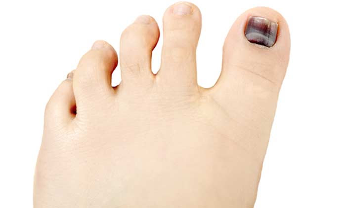 Hammertoes Patient - L.A. Orthopedic & Pain Center