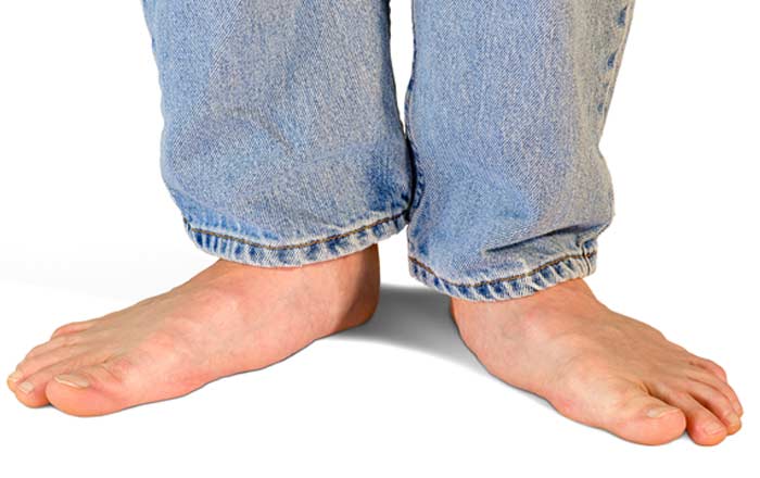 Man with Flat Feet & High Arches - L.A. Orthopedic & Pain Center