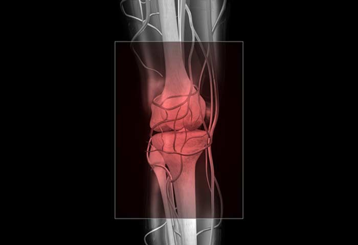 Myofascial Pain Syndrome - L.A. Orthopedic & Pain Center