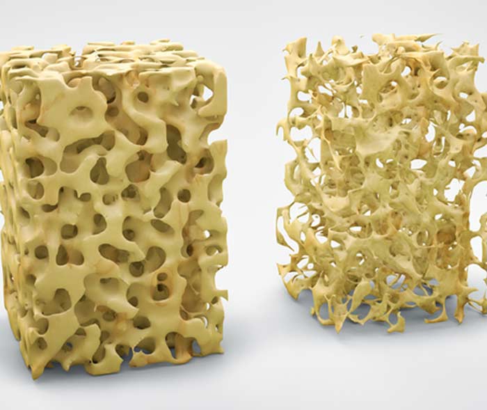 Osteoporosis-L.A.-Orthopedic-&-Pain-Center