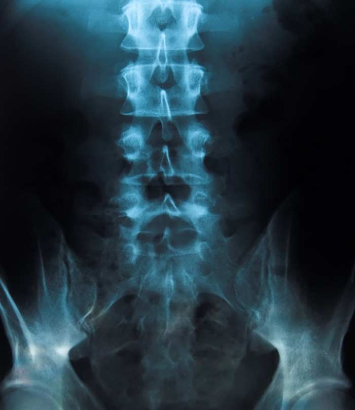 Sacroiliac Joint Injection - L.A. Orthopedic & Pain Center