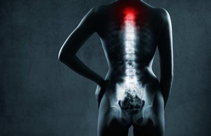 Spinal Fusion L.A. Orthopedic & Pain Center