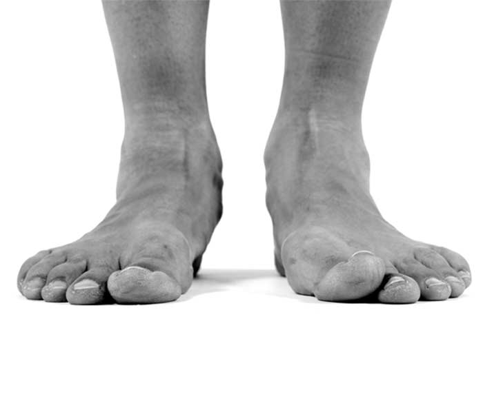 Surgical Flat Foot Correction - L.A. Orthopedic & Pain Center