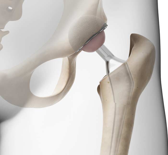 Total Joint Replacement - L.A. Orthopedic & Pain Center