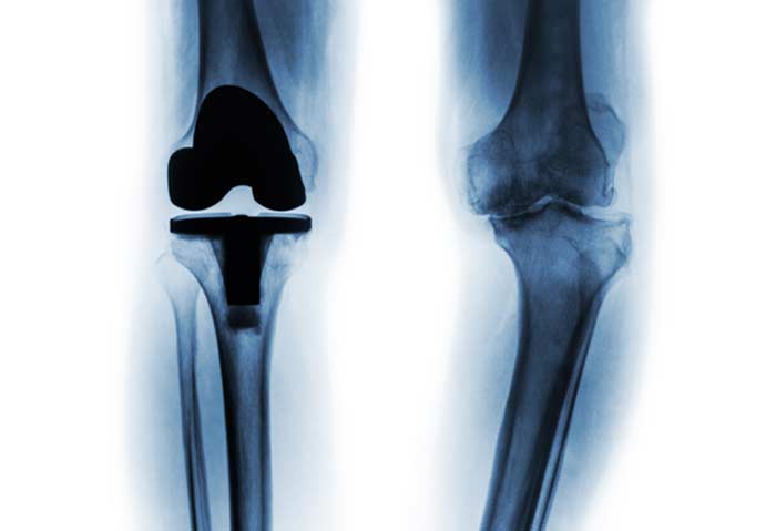 Total Joint Replacement - L.A. Orthopedic & Pain Center