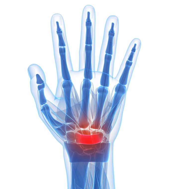 X-Ray of Carpal Tunnel Syndrome Patient - L.A. Orthopedic & Pain Center