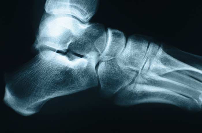 X-Ray of Fractures - L.A. Orthopedic & Pain Center