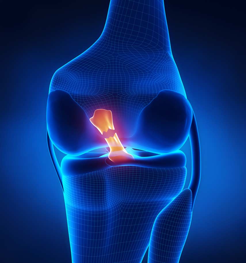 torn-meniscus-LA-Ortho-Pain