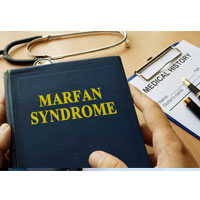 Understanding Marfan Syndrome - LA Orthopedic & Pain Center